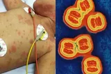 Tưởng tiêm vaccine não mô cầu là đủ, nhiều phụ huynh có thể đang hiểu nhầm điều này!