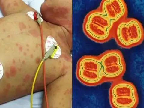 Tưởng tiêm vaccine não mô cầu là đủ, nhiều phụ huynh có thể đang hiểu nhầm điều này!